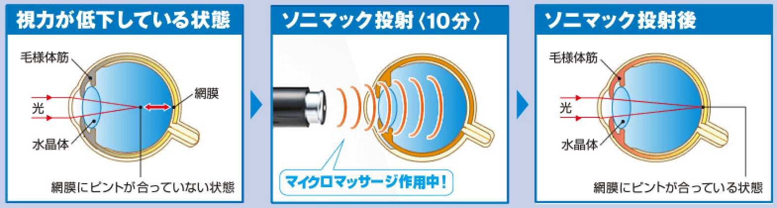 超音波治療のイメージ